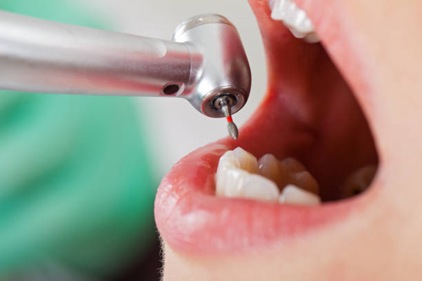 Best Emergency Wisdom Teeth Removal in Nags Head, NC